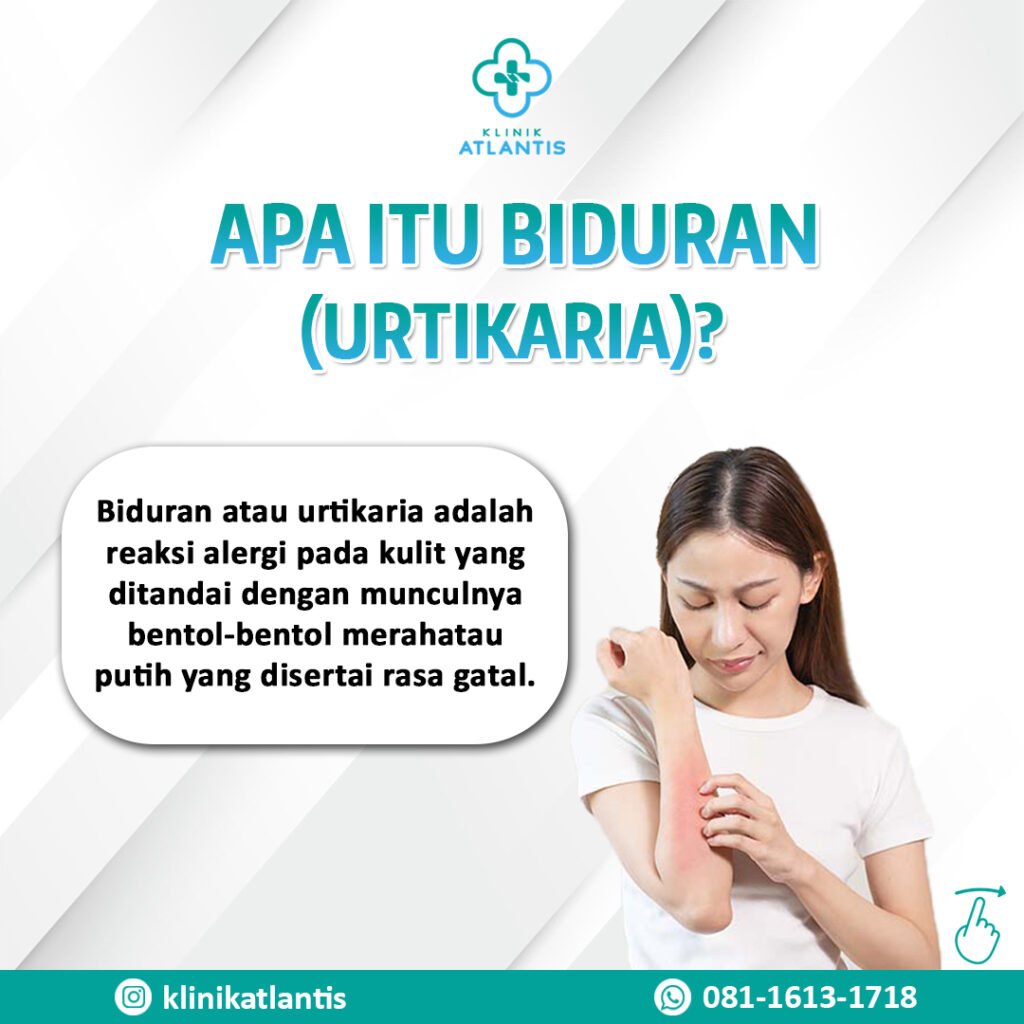 10 Penyebab Biduran yang Perlu Anda Waspadai dan Cara Mengatasinya 1 04 09 24 a 1024x1024 1