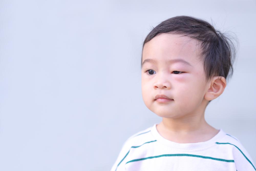 6d9caeaa mata bengkak pada anak