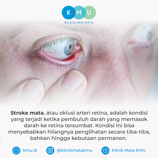 Stroke Mata, Ketahui Mulai dari Gejala, Penyebab dan Pengobatannya: Panduan Lengkap 2 SM Pengertian Stroke Mata