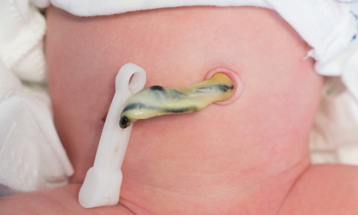 a knotty question when to clamp the umbilical cord 992 10 59 852111