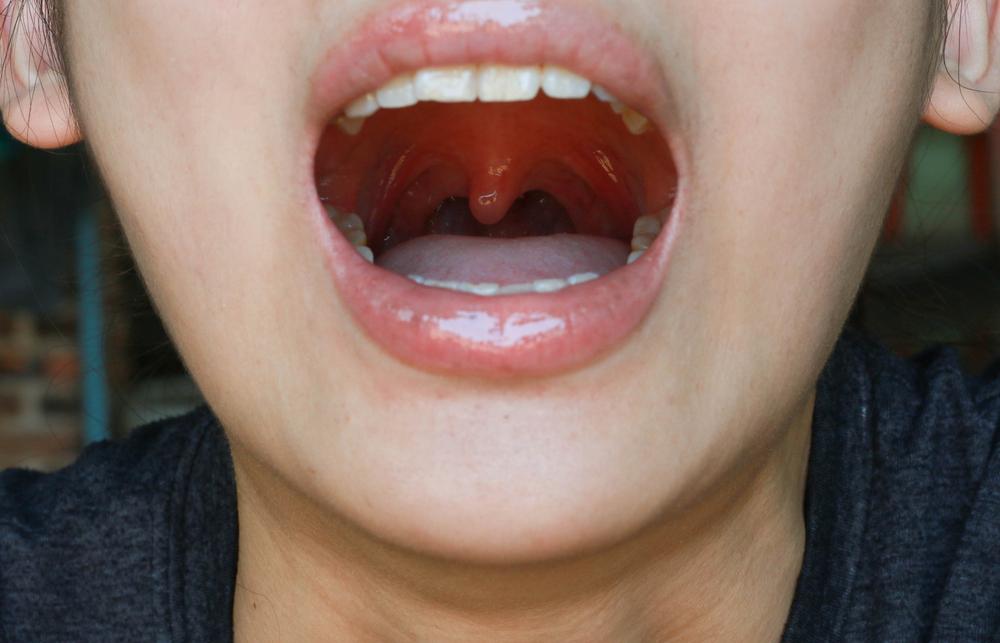 Memahami Penyebab dan Cara Mengatasi Ketika Uvula Bengkak: Panduan Lengkap 1 efb7089d uvula bengkak