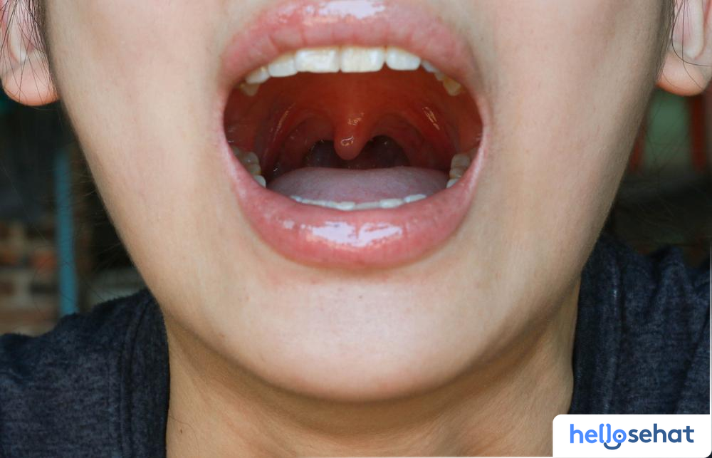 Memahami Penyebab dan Cara Mengatasi Ketika Uvula Bengkak: Panduan Lengkap 3 efb7089d uvula bengkak