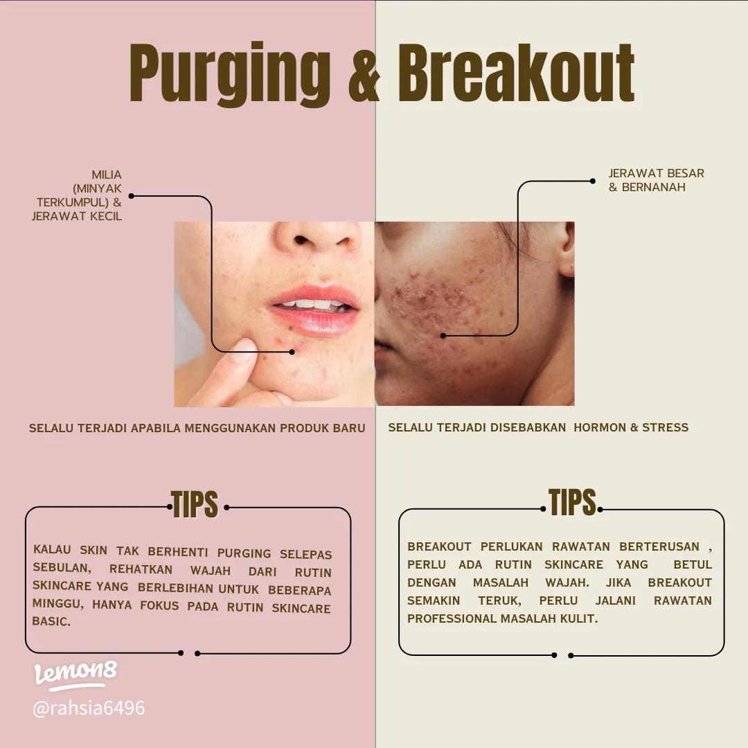 Apa Itu Purging? Ini Bedanya dengan Jerawat Breakout: Panduan Lengkap 1