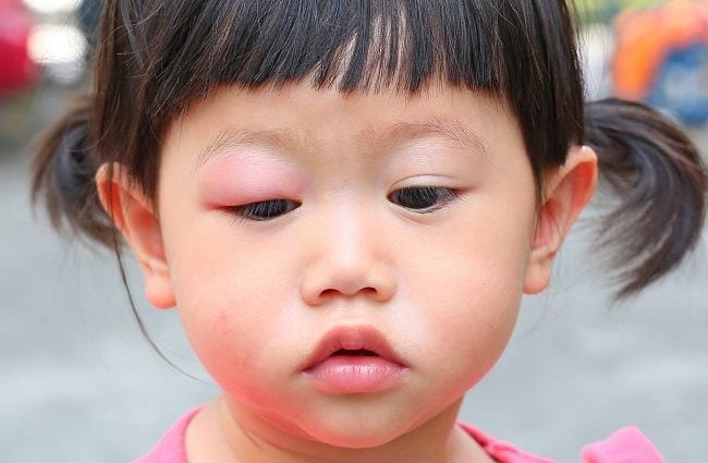 ini penyebab dan cara mengatasi infeksi mata pada anak