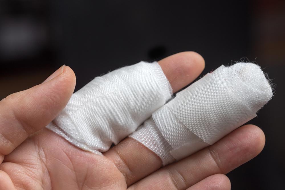 Apakah Jari Tangan yang Putus Bisa Disambung Kembali? Ini Penjelasan Medisnya 2 jari putus
