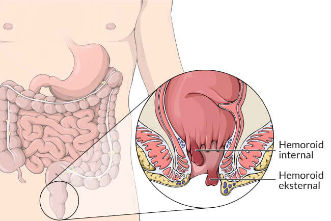 wasir hemoroid